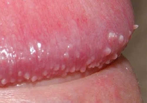 nổi mụn trắng bao quy đầu