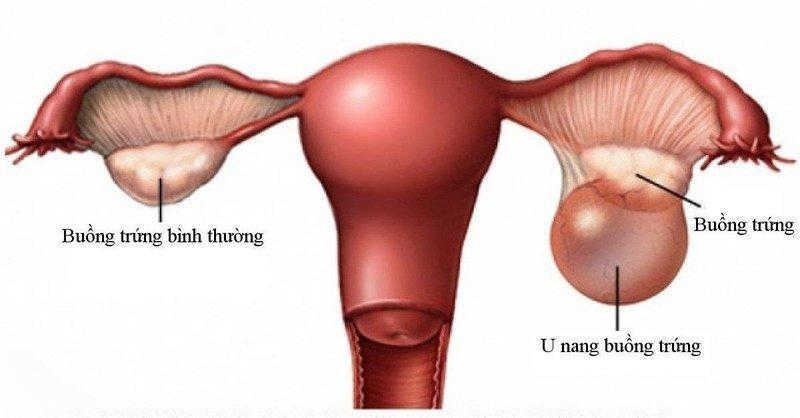 Viêm buồng trứng có thể hình thành u nang, gây hại đến sức khỏe sinh sản
