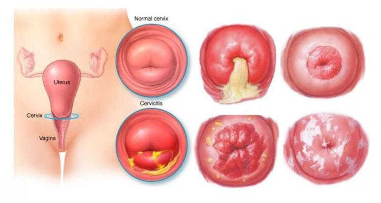 hình ảnh viêm cổ tử cung ở người phụ nữ