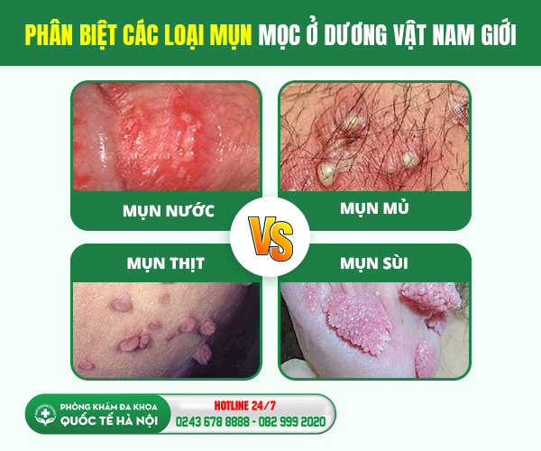 mụn dương vật
