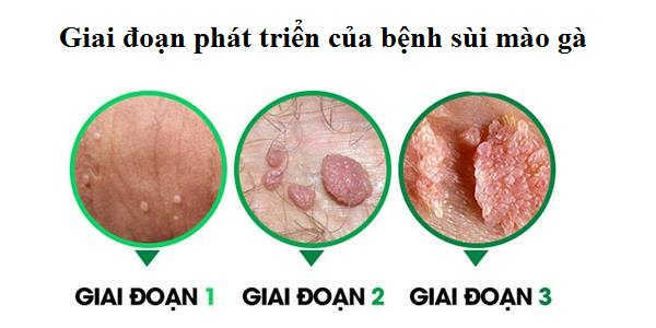 giai đoạn bệnh sùi mào gà