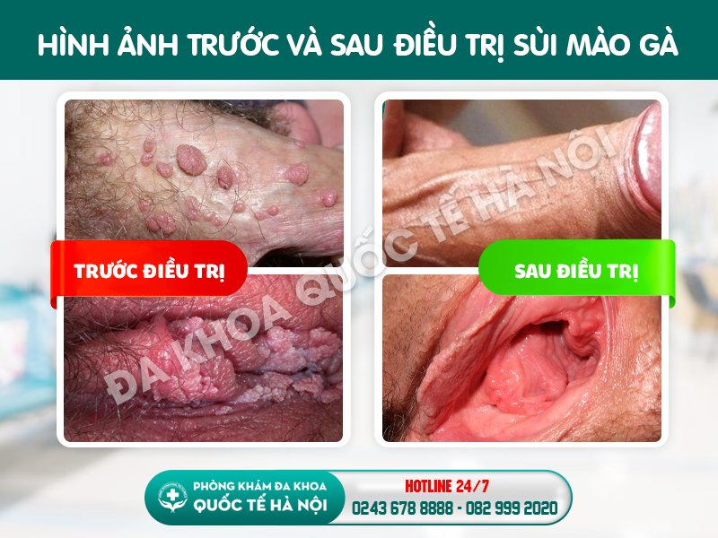 trước và sau khi điều trị sùi