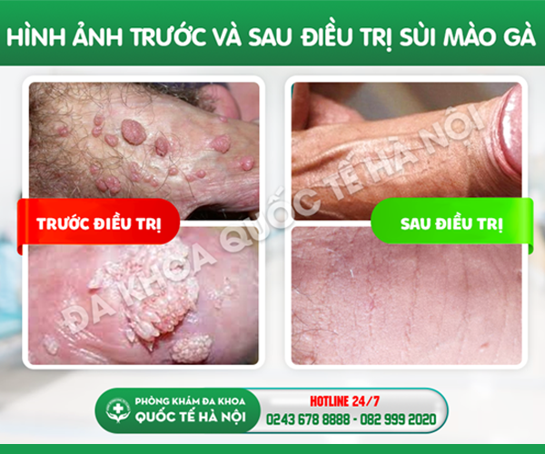 ảnh trước sau điều trị sùi