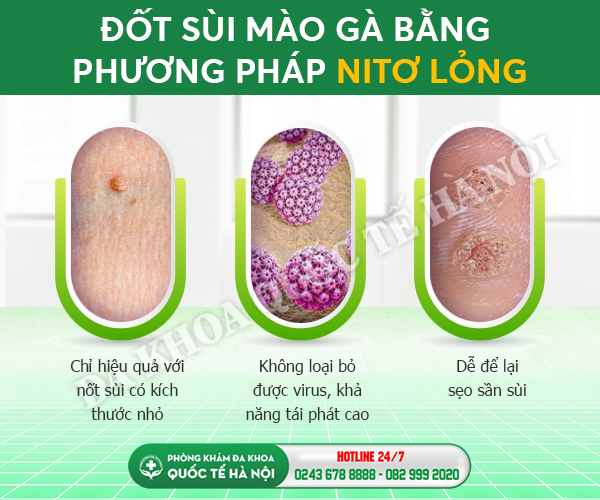 đốt sùi mào gà bằng nito lỏng