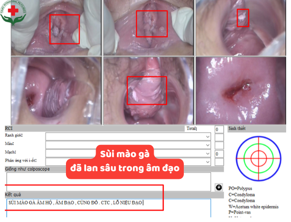 sùi mào gà âm đạo