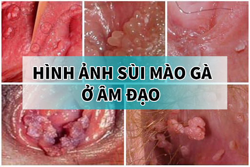 sùi mào gà ở âm đạo