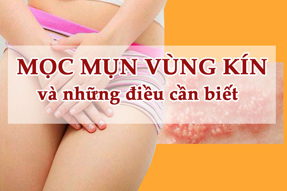 6-truong-hop-noi-mun-sinh-duc-nam-nu-khi-nao-can-di-kham